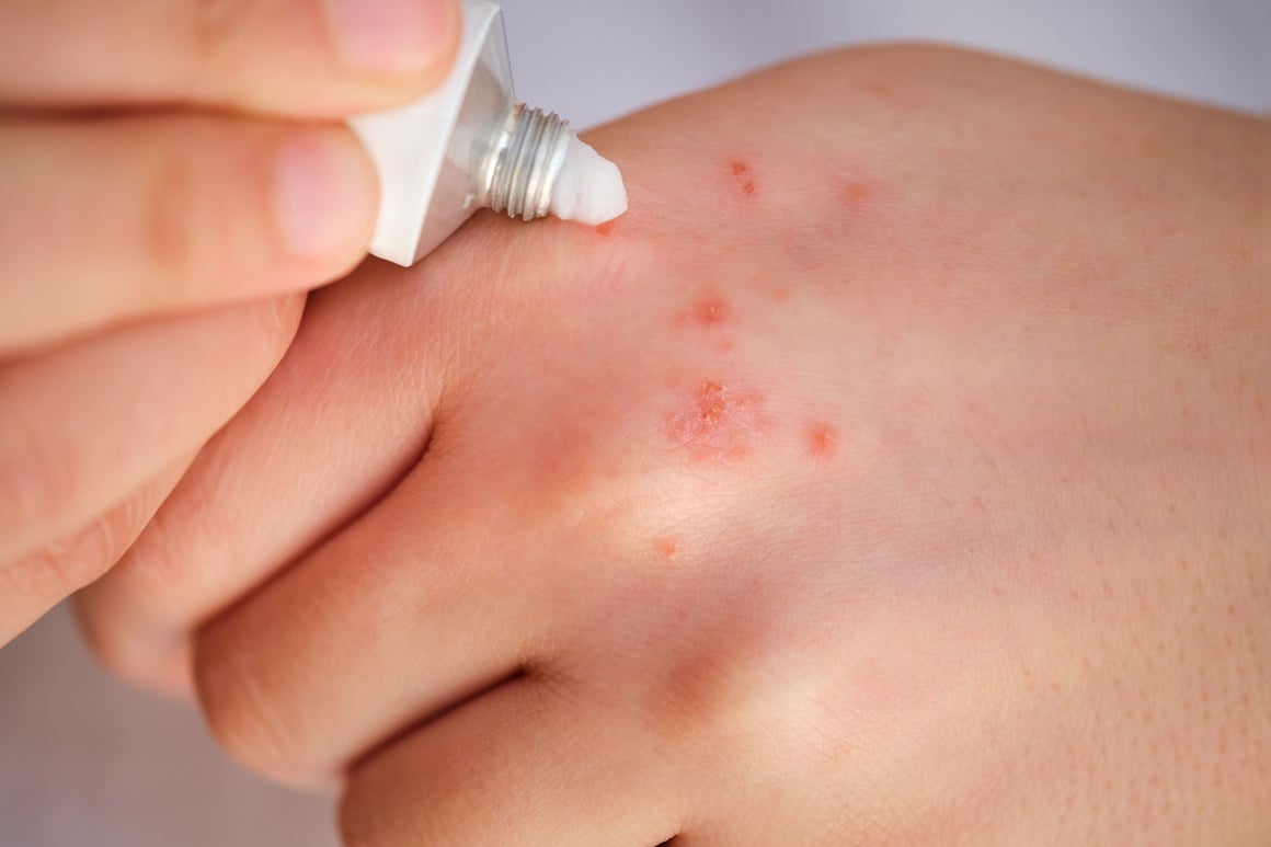 nova krema za dermatitis šaka