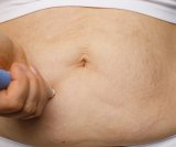 osobe koje koriste najčešće propisivane lijekove za mršavljenje u stvarnom životu ne gube toliko kilograma kao sudionici kliničkih ispitivanja