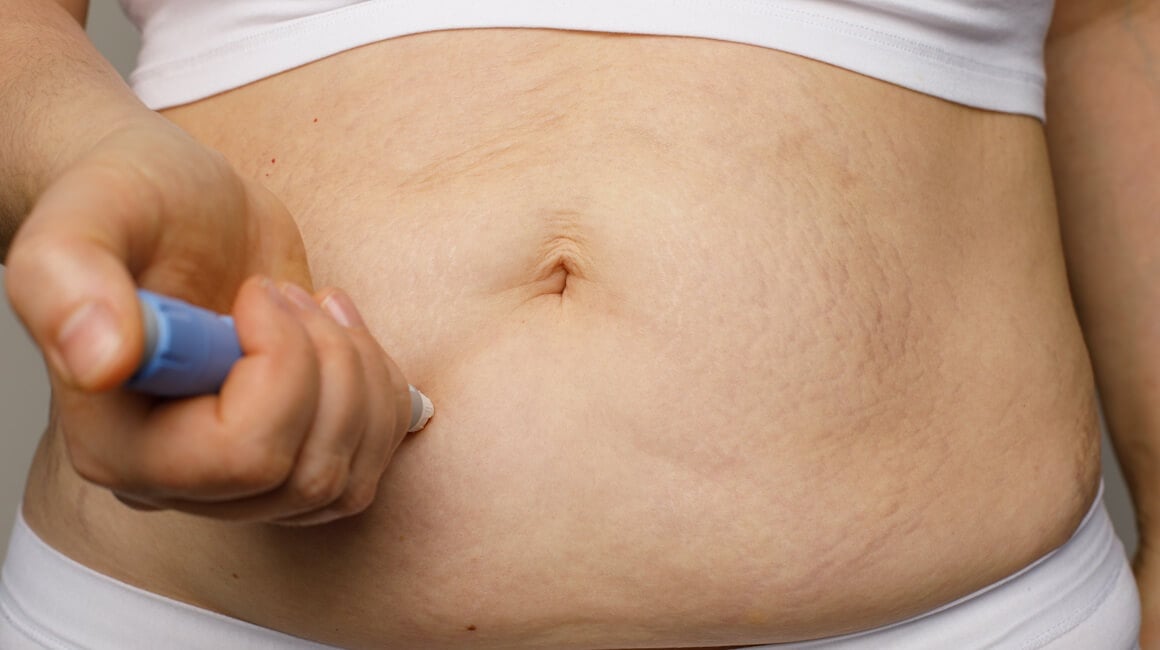 osobe koje koriste najčešće propisivane lijekove za mršavljenje u stvarnom životu ne gube toliko kilograma kao sudionici kliničkih ispitivanja