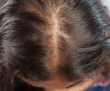Brzina ponovnog rasta kose nakon epizode alopecije razlikuje se od osobe do osobe