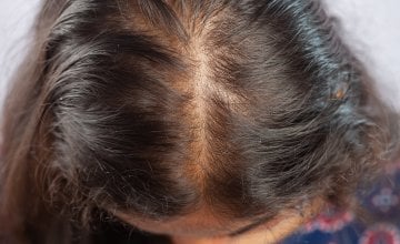 Brzina ponovnog rasta kose nakon epizode alopecije razlikuje se od osobe do osobe