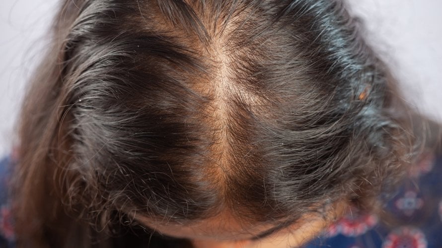 Brzina ponovnog rasta kose nakon epizode alopecije razlikuje se od osobe do osobe