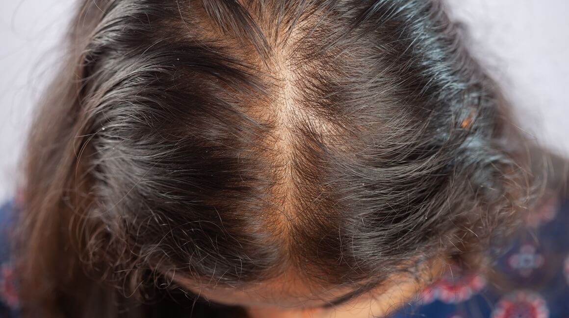 Brzina ponovnog rasta kose nakon epizode alopecije razlikuje se od osobe do osobe