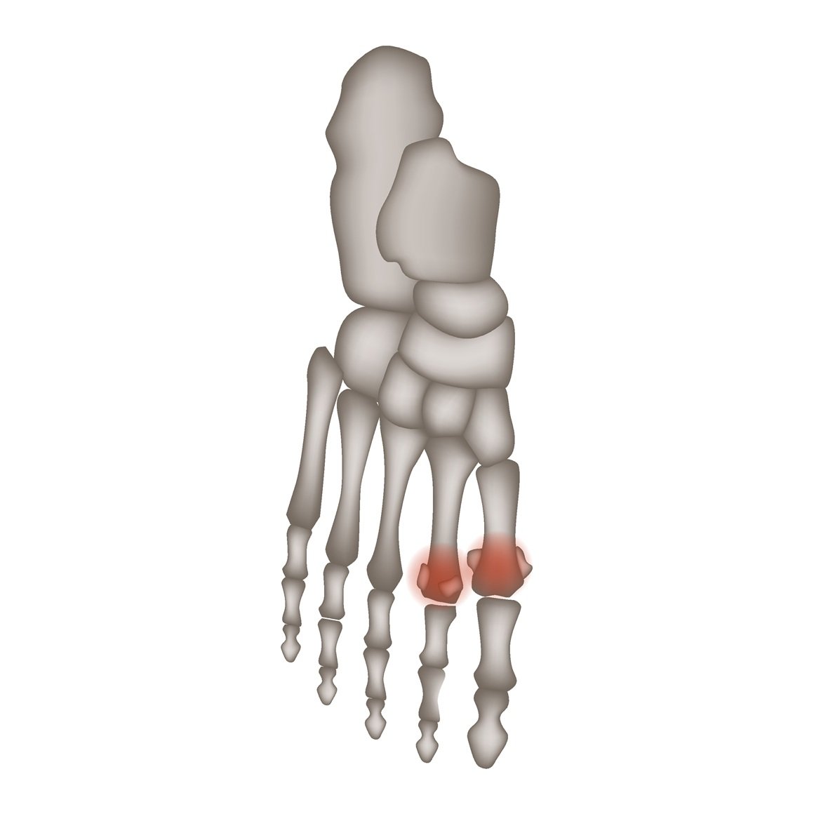 Freibergova osteohondroza ili Freibergova nekroza