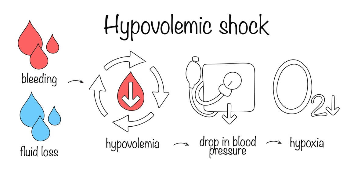 Hipovolemijski šok - uzroci