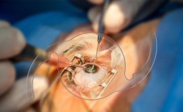 Katarakta (mrena) je jedno od najčešćih očnih oboljenja koje obično pogađa stariju populaciju