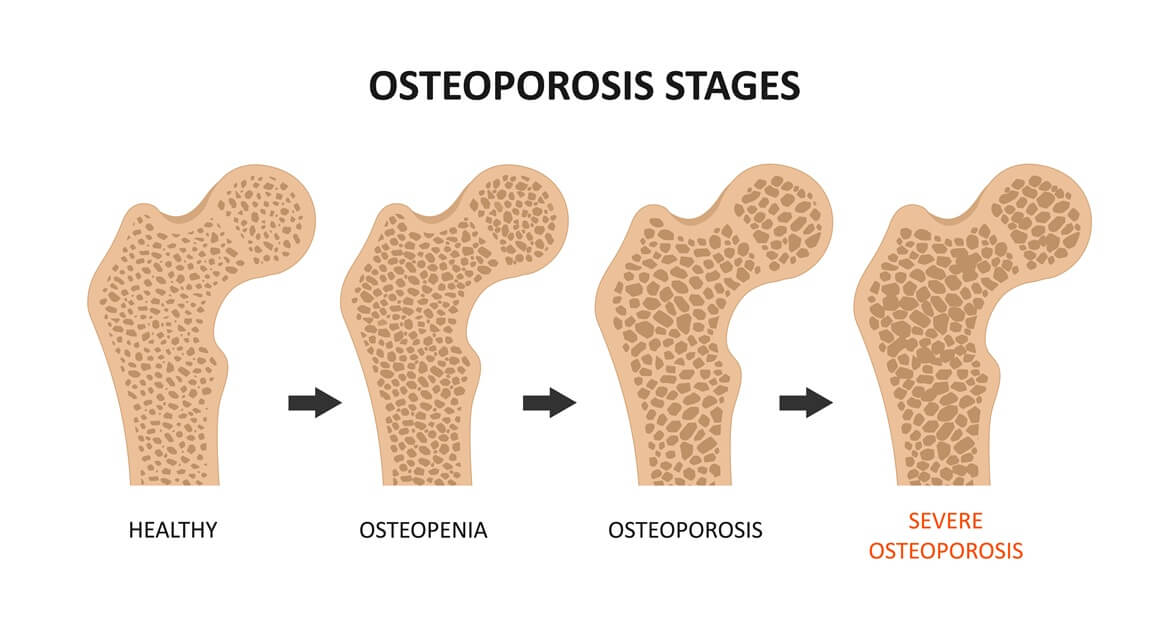 Liječenje osteopenije