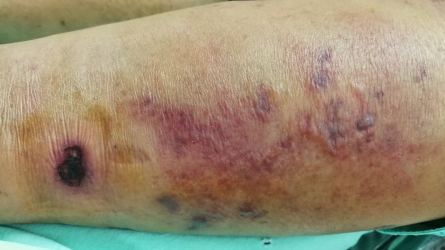 Nekrotizirajući fasciitis