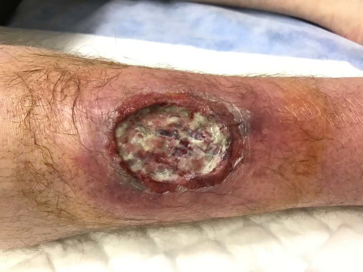 Nekrotizirajući fasciitis - liječenje