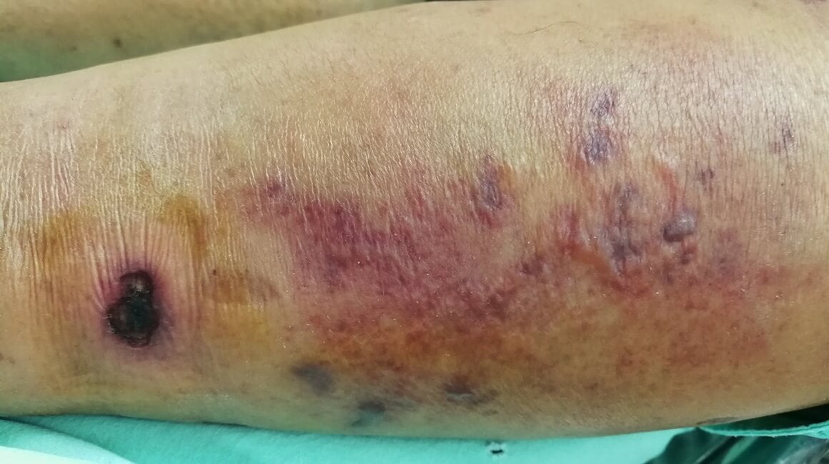 Nekrotizirajući fasciitis