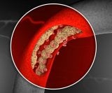 Povišeni LDL znači da u krvi imate previše lošeg kolesterola, koji se može taložiti na stijenkama arterija i stvarati plakove