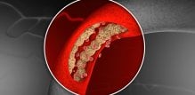 Povišeni LDL znači da u krvi imate previše lošeg kolesterola, koji se može taložiti na stijenkama arterija i stvarati plakove