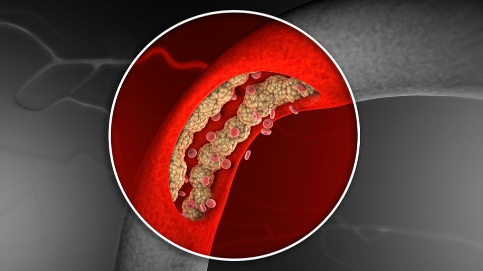 Povišeni LDL znači da u krvi imate previše lošeg kolesterola, koji se može taložiti na stijenkama arterija i stvarati plakove