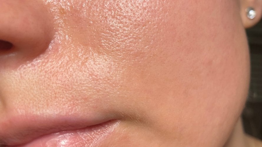 Prehrana utječe na hormone, a hormoni reguliraju brojne procese u tijelu, uključujući i izgled kože