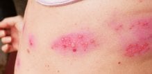 herpes zoster - virusna infekcija koja zahvaća živce, uzrokuje bol u području prsa prije nego se pojavi karakterističan osip