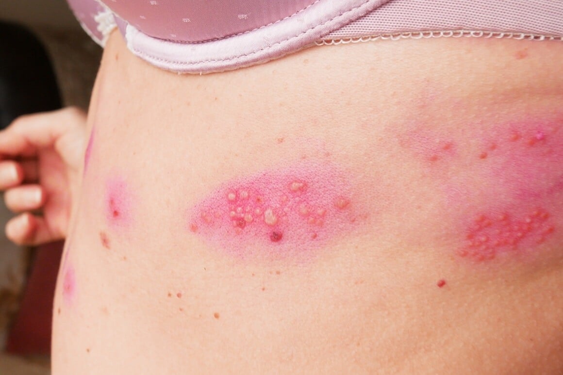 herpes zoster - virusna infekcija koja zahvaća živce, uzrokuje bol u području prsa prije nego se pojavi karakterističan osip