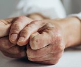 komplikacije psorijatičnog artritisa