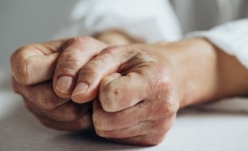 komplikacije psorijatičnog artritisa