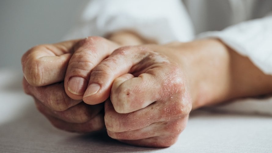 komplikacije psorijatičnog artritisa