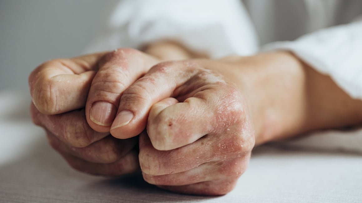 komplikacije psorijatičnog artritisa