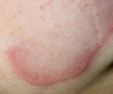 Anularni granulom