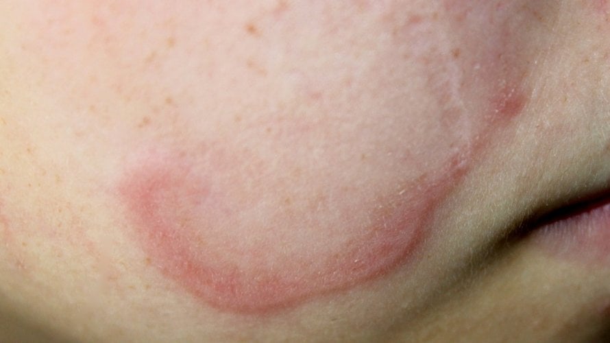Anularni granulom