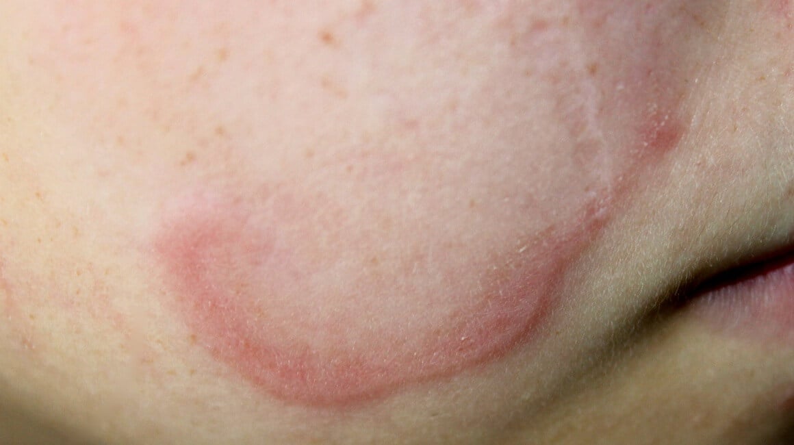 Anularni granulom