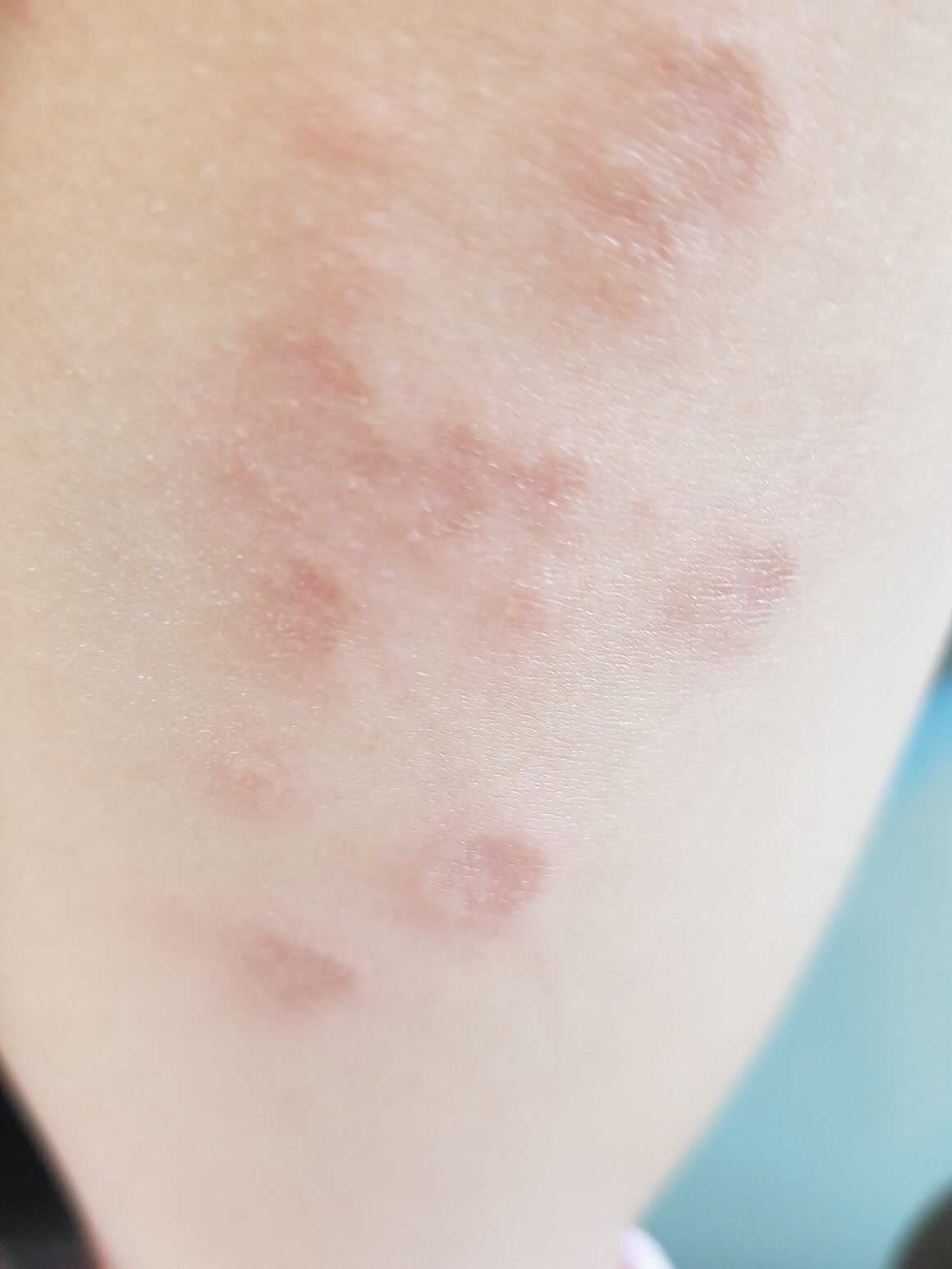 Granuloma annulare