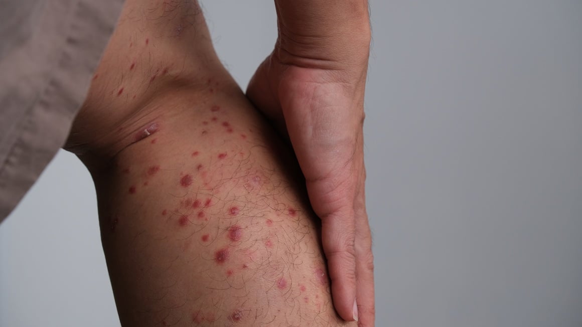 Gutatna psorijaza