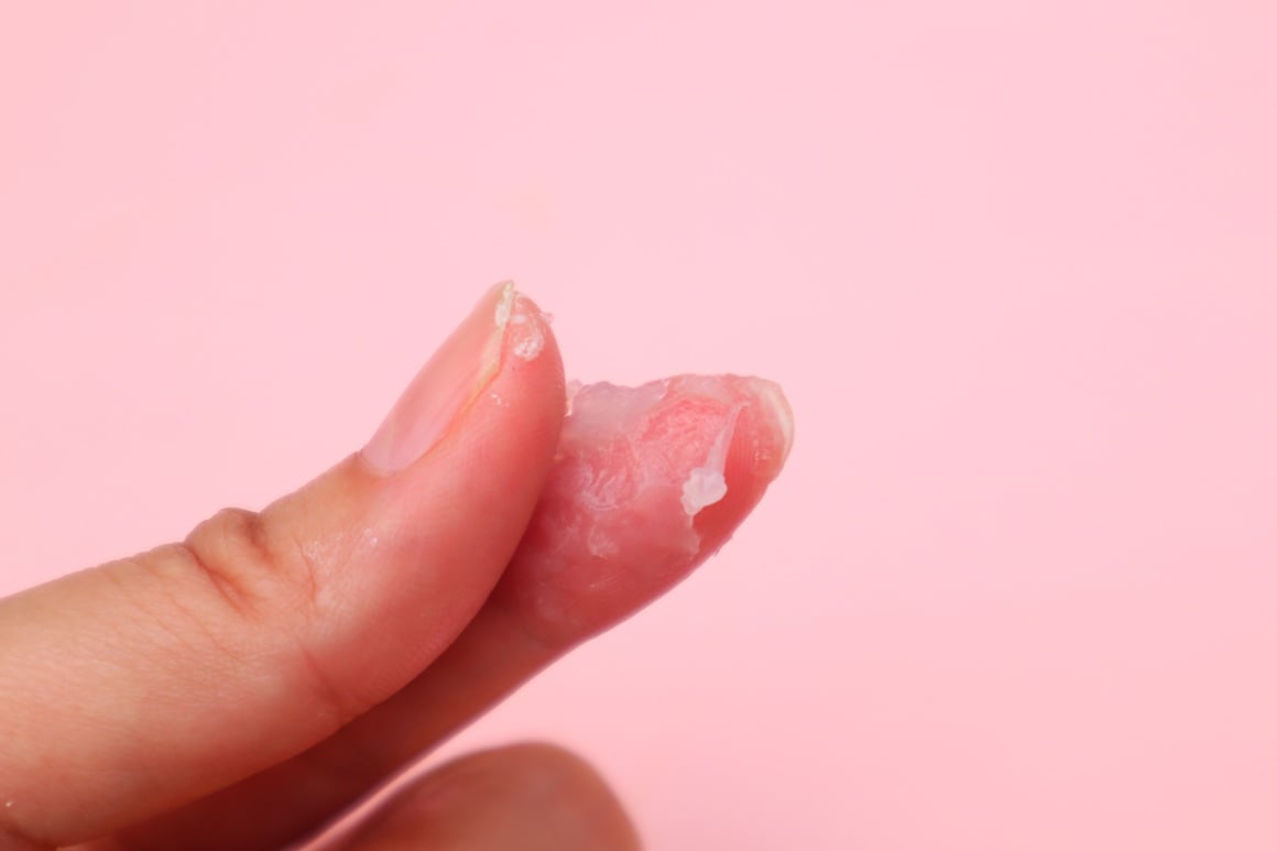 Iscjedak kao bjelanjak najčešće se javlja oko dva tjedna nakon menstruacije i obično označava plodne dane