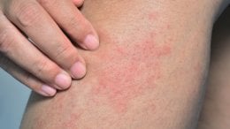 Kronična urtikarija može biti vrlo neugodna i frustrirajuća