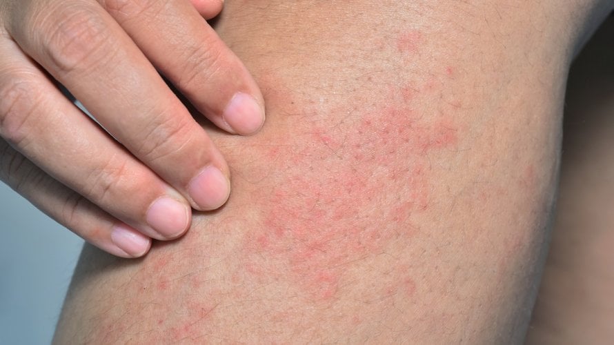 Kronična urtikarija može biti vrlo neugodna i frustrirajuća