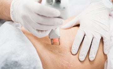 Lasersko uklanjanje strija