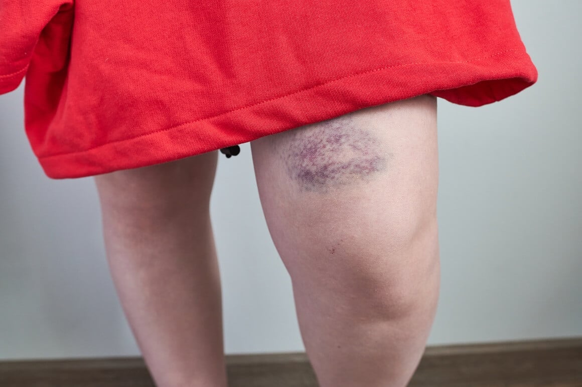 Prosječna modrica obično traje oko dva tjedna
