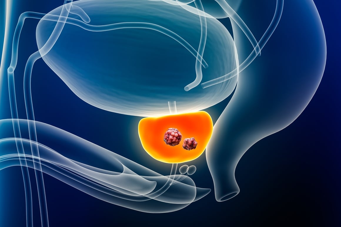 Stadiji raka prostate