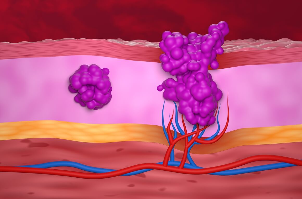 Benigni i maligni tumori - razlika