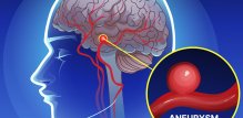 Cerebralne aneurizme češće se pojavljuju kod žena