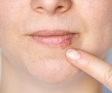 Kada herpes prestaje biti zarazan