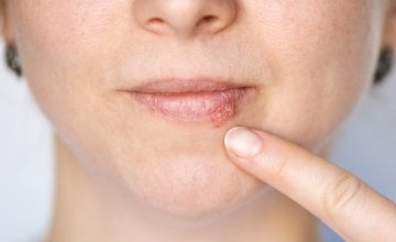 Kada herpes prestaje biti zarazan