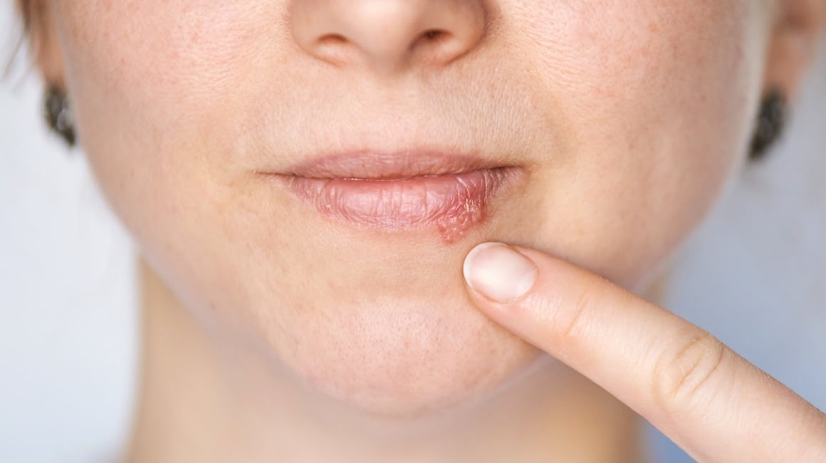 Kada herpes prestaje biti zarazan
