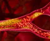 Kolesterol je često nevidljiv problem - ne boli, ne pokazuje se na prvi pogled, ali može ozbiljno ugroziti zdravlje srca i krvnih žila