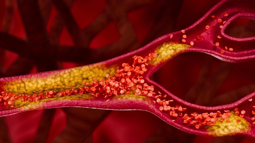 Kolesterol je često nevidljiv problem - ne boli, ne pokazuje se na prvi pogled, ali može ozbiljno ugroziti zdravlje srca i krvnih žila