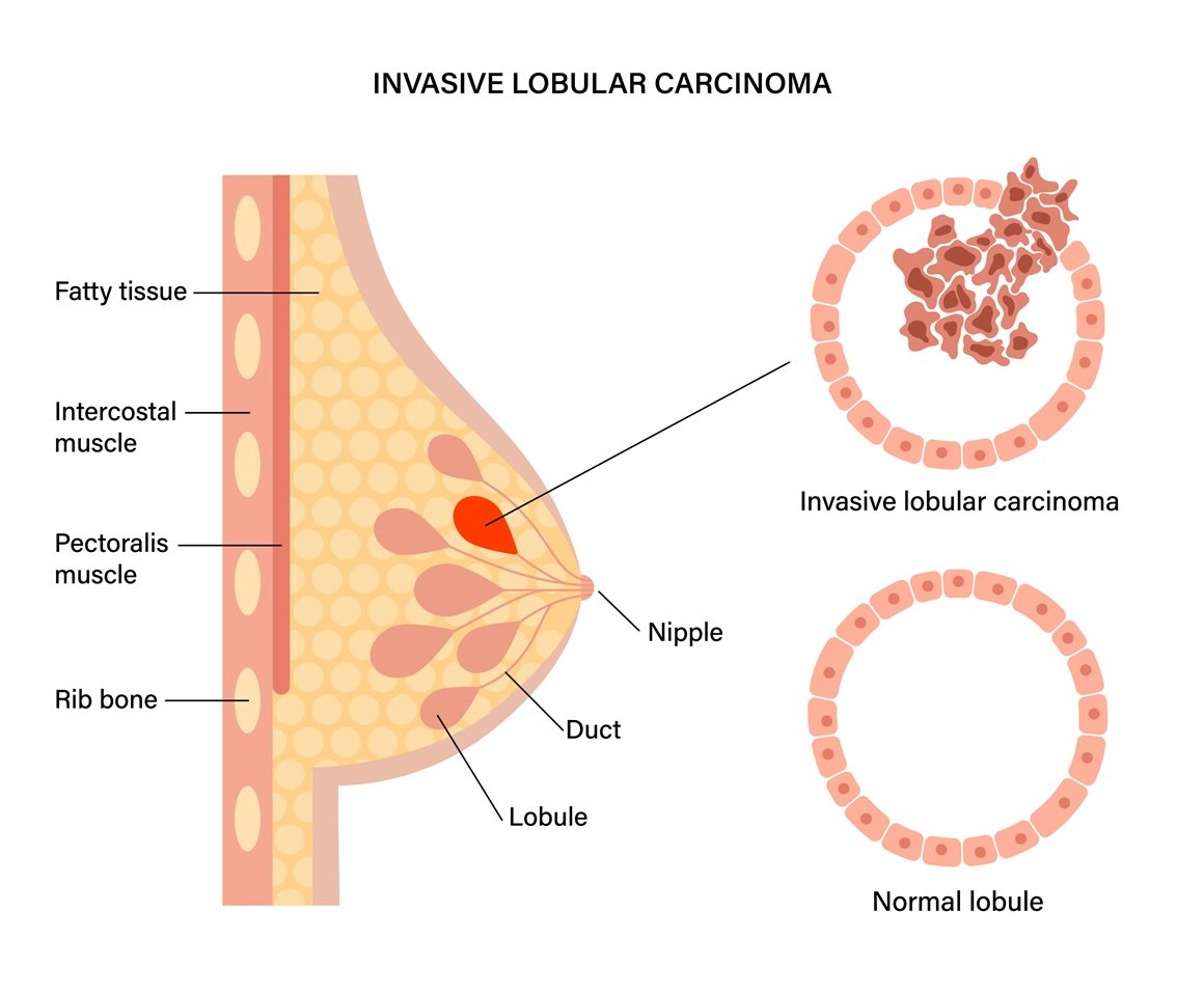 Lobularni karcinom dojke (ili invazivni lobularni karcinom) nastaje u mliječnim žlijezdama, odnosno lobulima