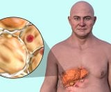 Masna bolest sve je češća diljem svijeta