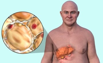 Masna bolest sve je češća diljem svijeta