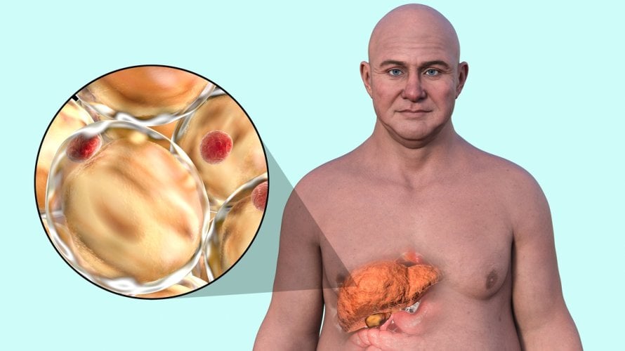 Masna bolest sve je češća diljem svijeta