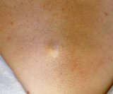 Može li benigni tumor postati maligni