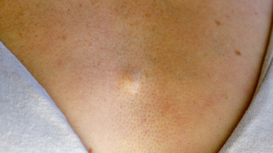 Može li benigni tumor postati maligni