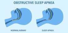 Opstruktivna apneja u snu ozbiljan je poremećaj disanja koji se javlja tijekom spavanja