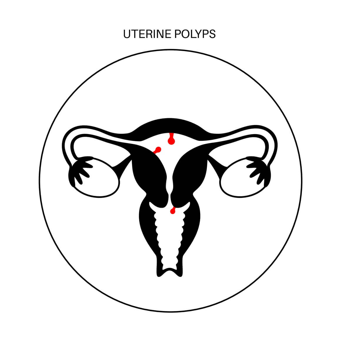 Polipi maternice